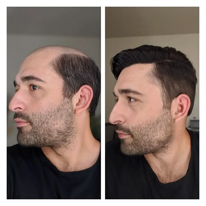 Hair Restoration Treatment Results